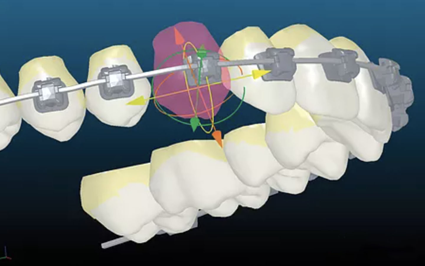 Orthodontie vestibulaire individualisé